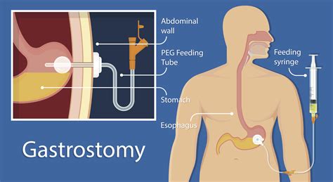 calore tube|Tube Feeding Resource Guide